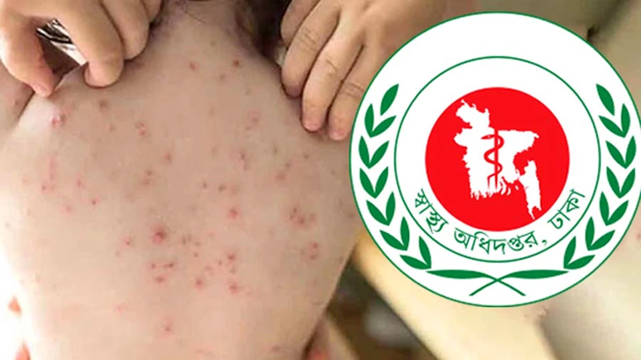 হাম ও উপসর্গ নিয়ে আরও ৪ জনের মৃত্যু