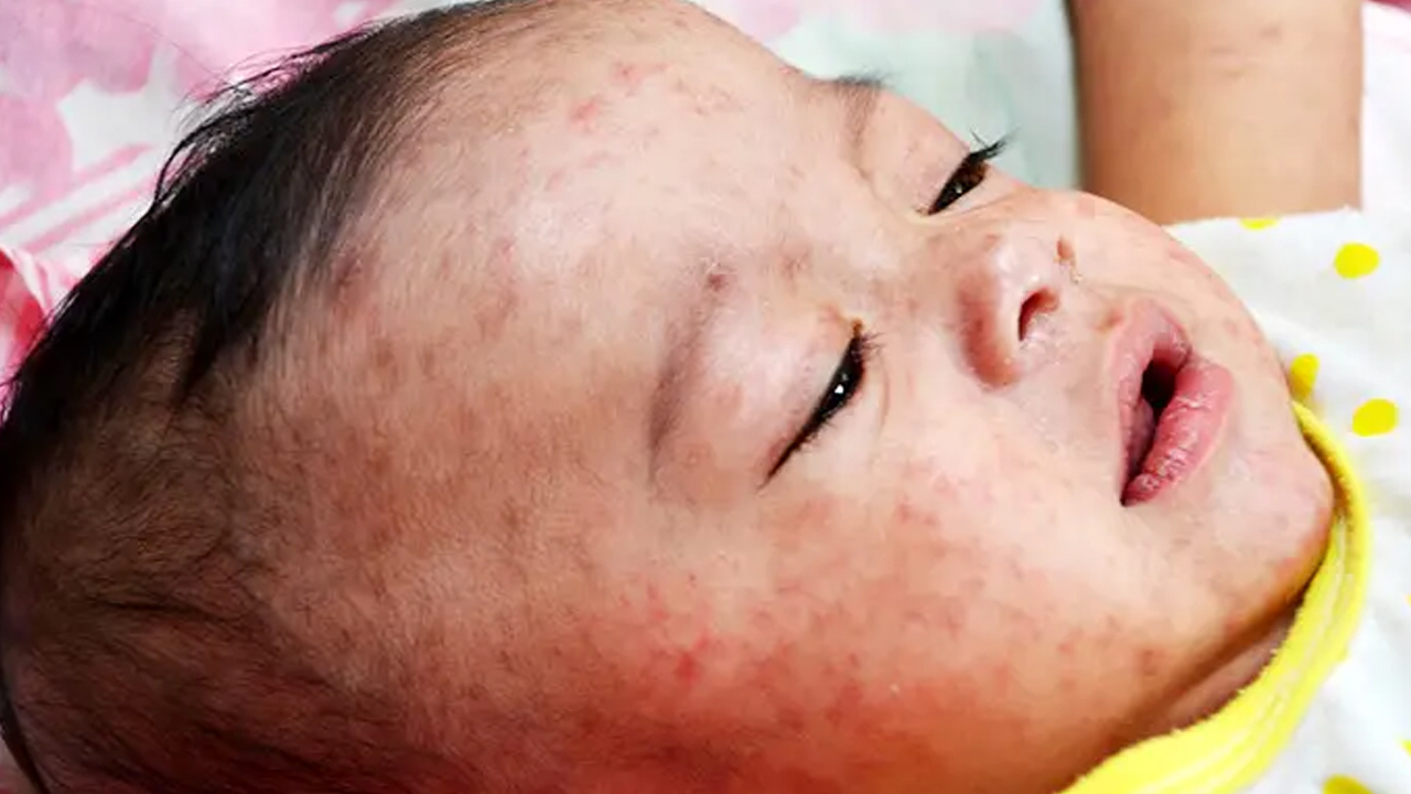 বাড়ছে হাম আতঙ্ক, আইসোলেশন সংকট