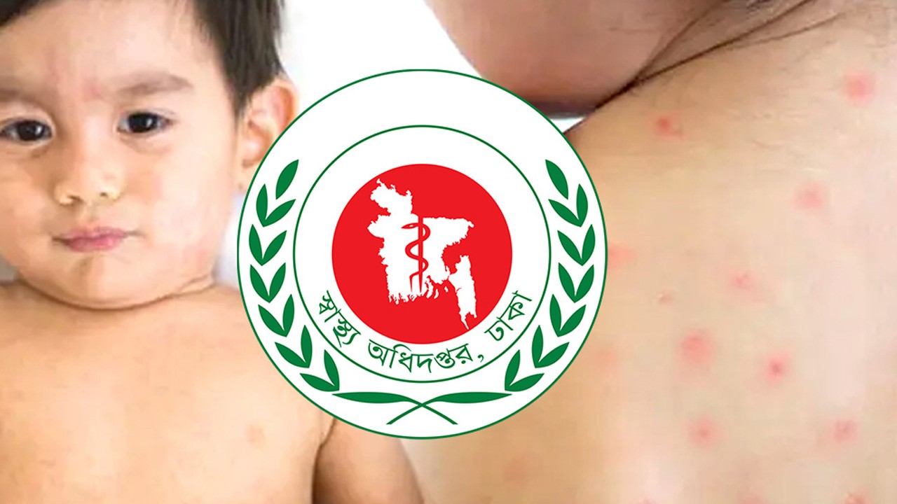 হামের উপসর্গ নিয়ে দেশে আরও ১০ শিশুর মৃত্যু