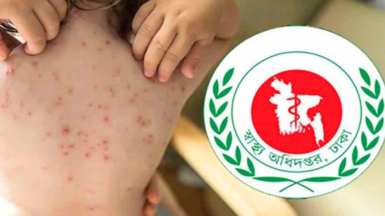 হামের উপসর্গ নিয়ে আরও ৯ মৃত্যু, শনাক্ত ১১০৫