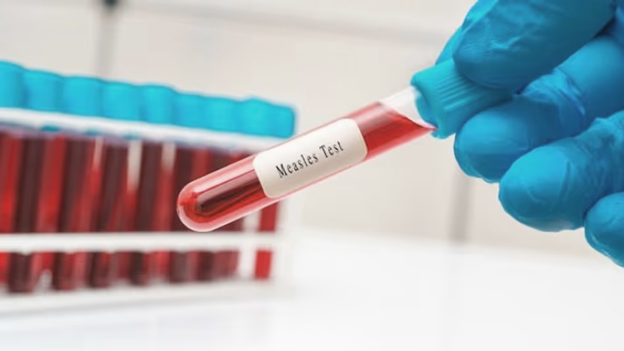 ৬ মাস বয়স থেকেই শিশুকে হামের টিকা দেবে সরকার