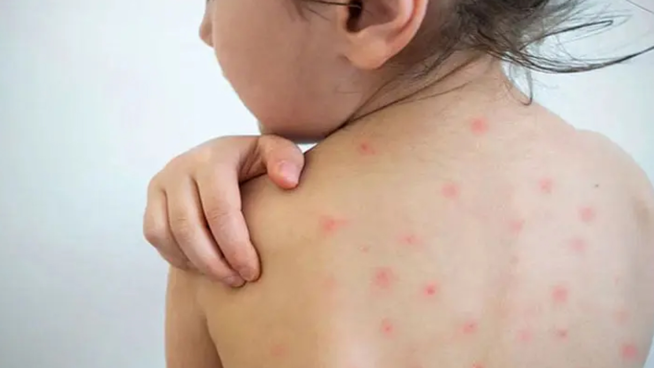 শিশুর হাম হলে আতঙ্ক নয়, করণীয় জানুন