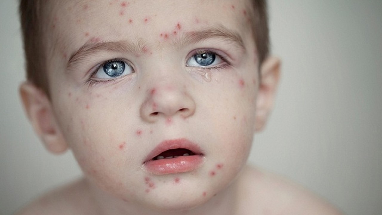 হাম ও উপসর্গে ২ জনের মৃত্যু, শনাক্ত ৮০