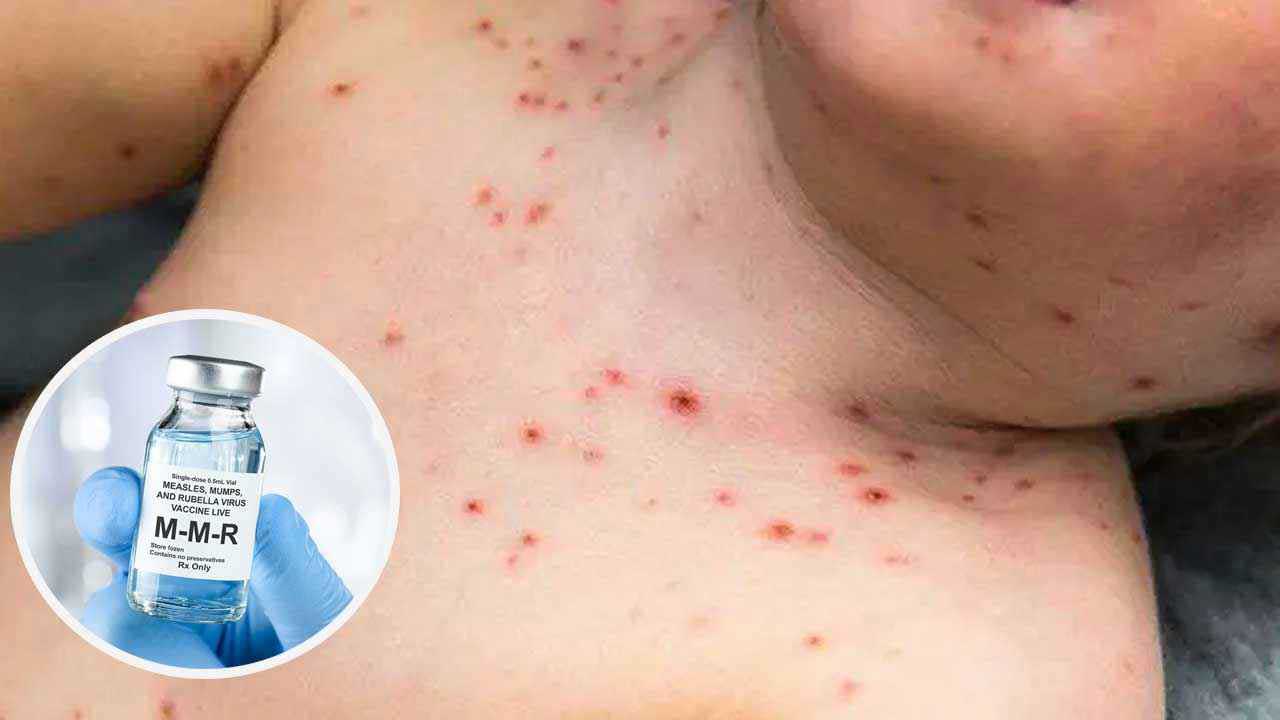 বাড়ছে হামের রোগী, যা জানা জরুরি